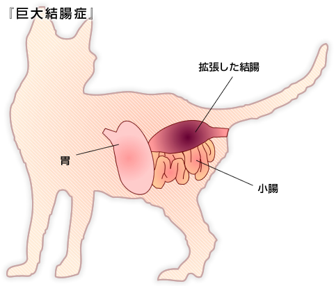 巨大結腸症