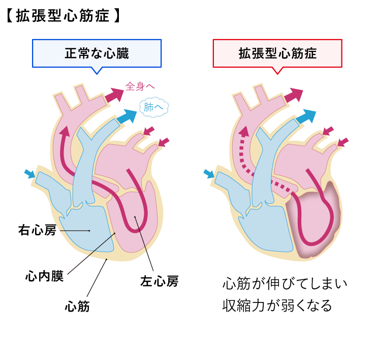 拡張型心筋症(図)