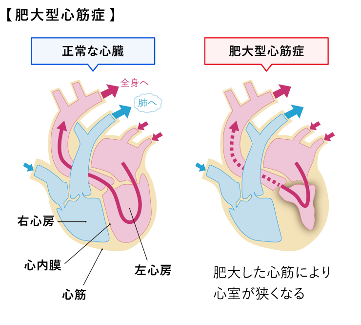 肥大型心筋症(図)