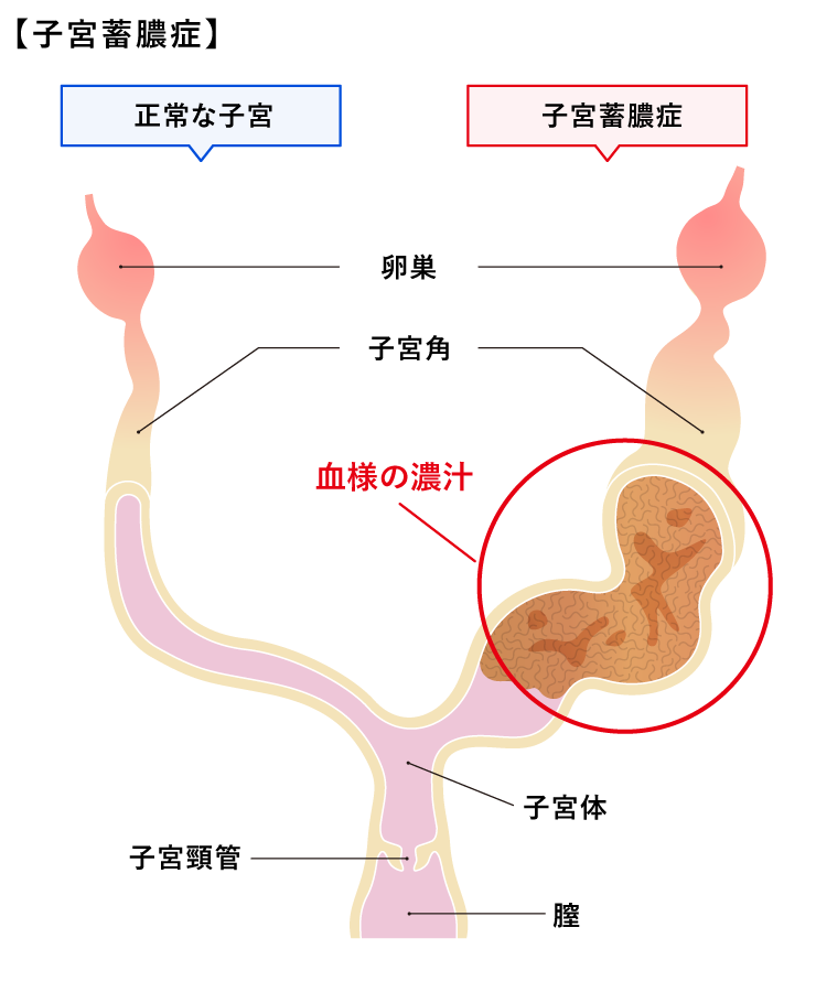 子宮蓄膿症＜犬＞図
